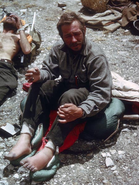 Барри Бишоп (Barry Bishop) с обмороженными пальцами после покорения Эвереста