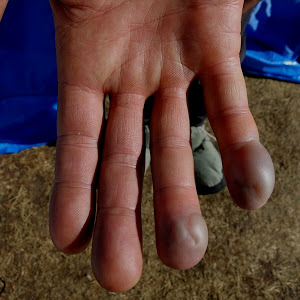 Чад Келлогг (Chad Kellogg) демонстрирует свои обмороженные пальцы