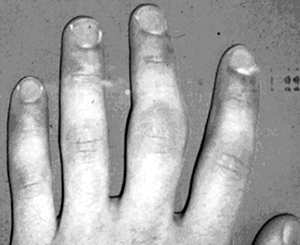 травма (переломов) эпифазарных пластин (отвечающих за рост) пальцев.