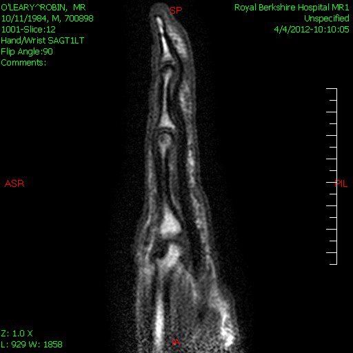 Снимок МРТ, на котором виден промежуток между костью и связкой, т.е. имеется полный разрыв