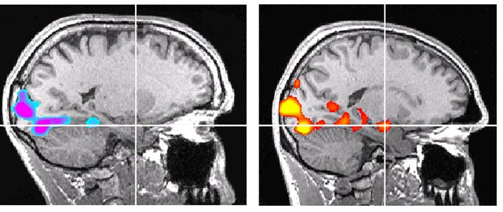Слева – мозг Хоннольда, справа – контрольного испытуемого, также альпиниста примерно того же возраста. В перекрестии находится миндалина. При взгляде на набор картинок у контрольного испытуемого миндалина активируется, а у Хоннольда остаётся полностью неактивной.
